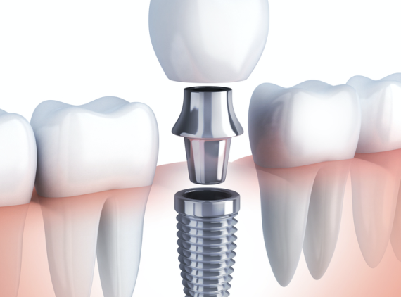 İmplant Tedavisi Nedir ve Nasıl Yapılır?
