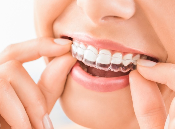 Invisalign Tedavisi Nedir? Nasıl Yapılır?