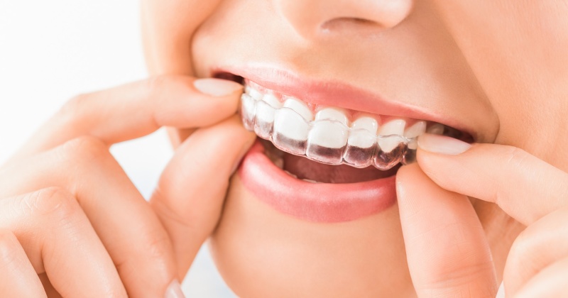 İnvisalign